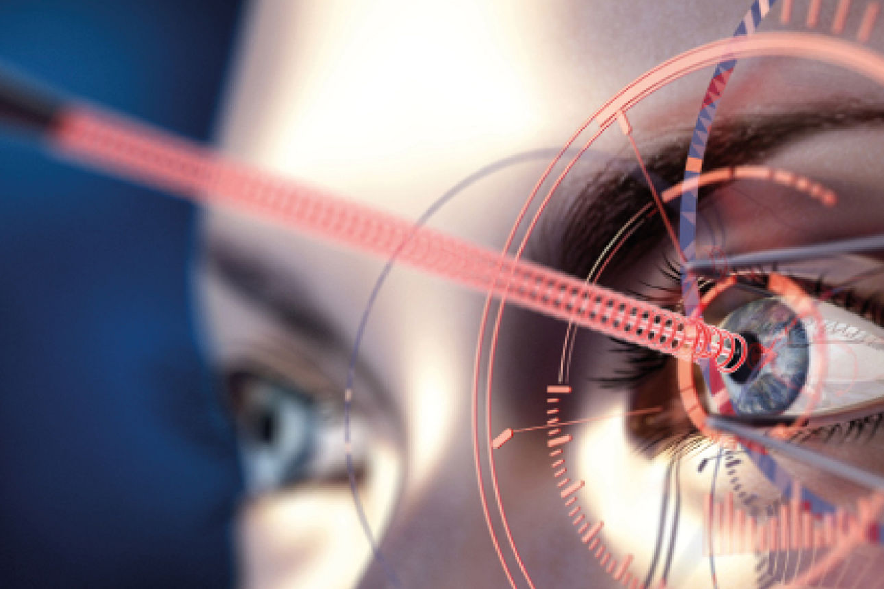 Bildliche Darstellung einer Augenlaserung