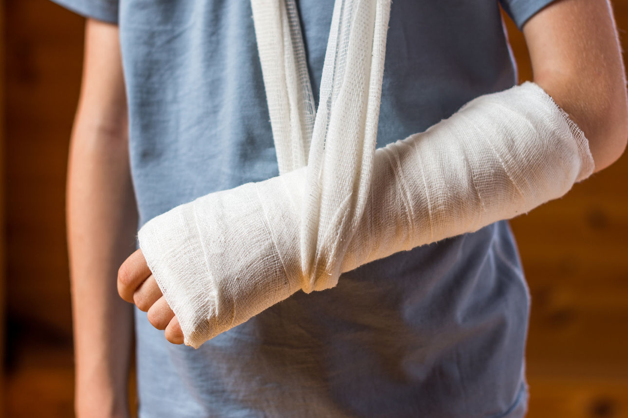 Unfallversicherung für Kinder Junge mit Gips um Arm hält seinen gebrochenen Arm hoch in einem blauen Tshirt